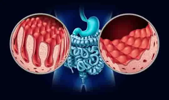 intestino enfermo imagen