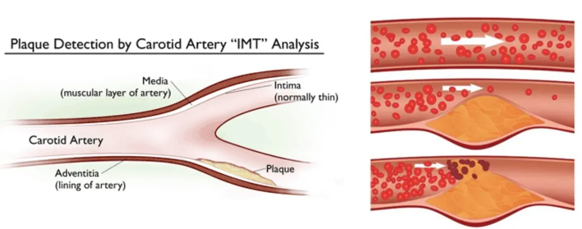 medición de la arteriosclerosis en la arteria carótida